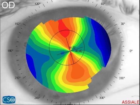 Topografia corneale e aberrometria oculare