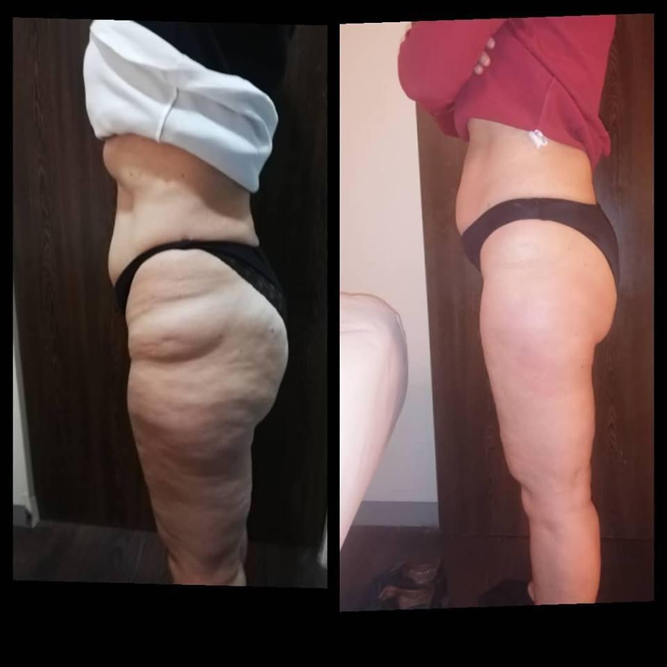 Trattamento MC1 per eliminare cellulite e grasso - LA VERA ALTERNATIVA ALLA LIPOSUZIONE