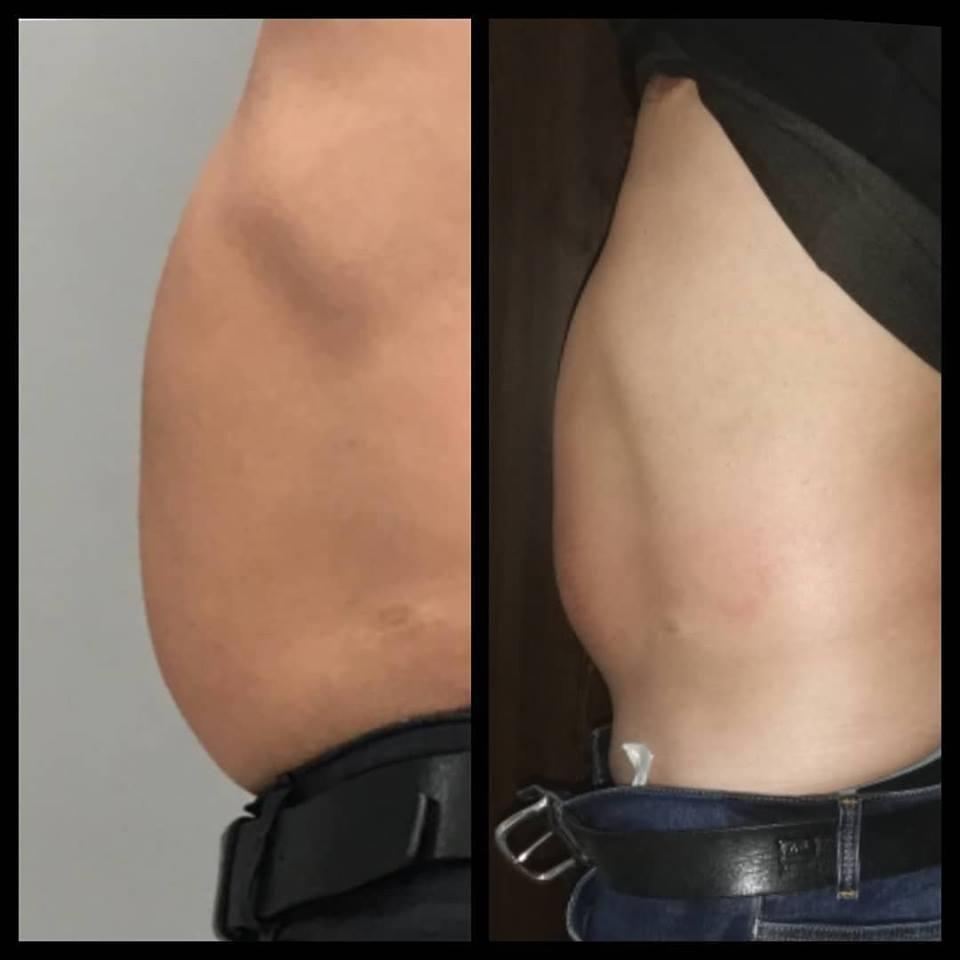 Trattamento MC1 a Palermo | Alternativa alla liposuzione per eliminare cellulite e grasso