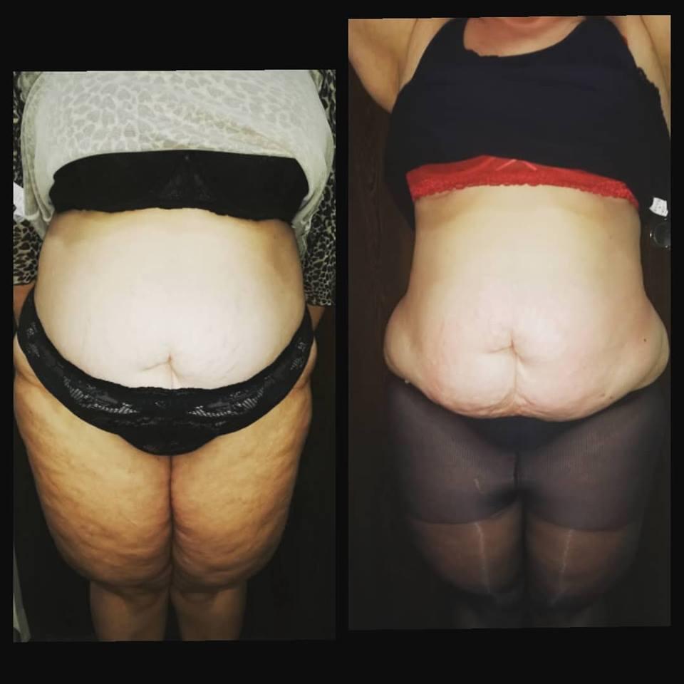 Trattamento MC1 a Palermo | Alternativa alla liposuzione per eliminare cellulite e grasso
