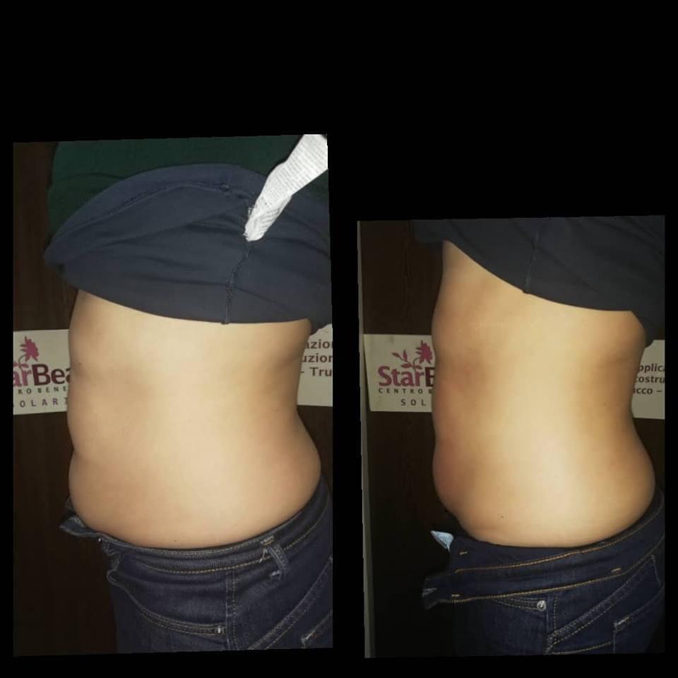 Trattamento MC1 a Palermo | Alternativa alla liposuzione per eliminare cellulite e grasso