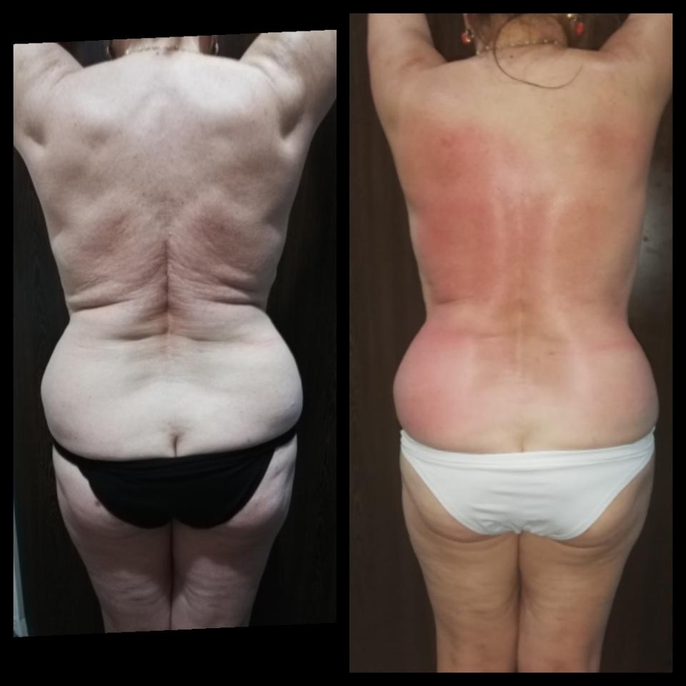 Trattamento MC1 a Palermo | Alternativa alla liposuzione per eliminare cellulite e grasso