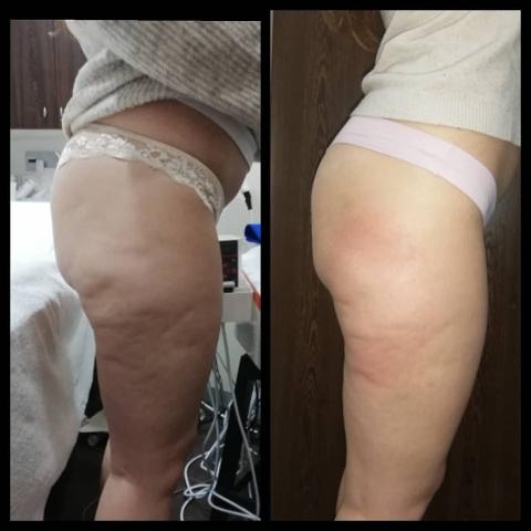 Trattamento MC1 per eliminare cellulite e grasso - LA VERA ALTERNATIVA ALLA LIPOSUZIONE