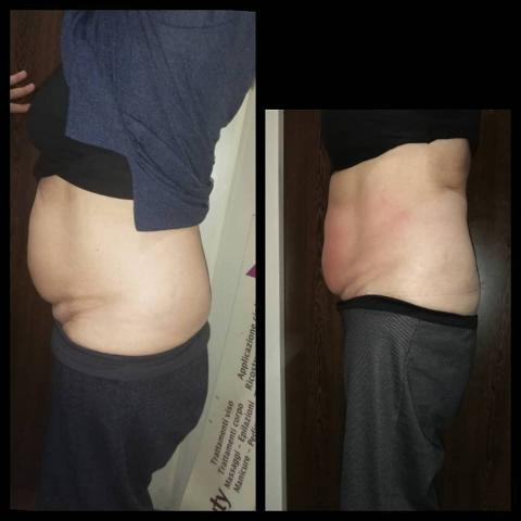 Trattamento MC1 per eliminare cellulite e grasso - LA VERA ALTERNATIVA ALLA LIPOSUZIONE