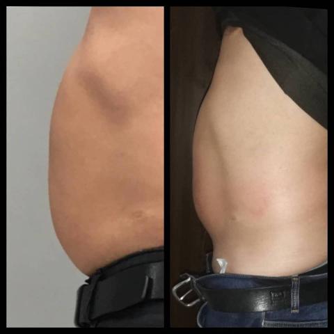 Trattamento MC1 a Palermo | Alternativa alla liposuzione per eliminare cellulite e grasso