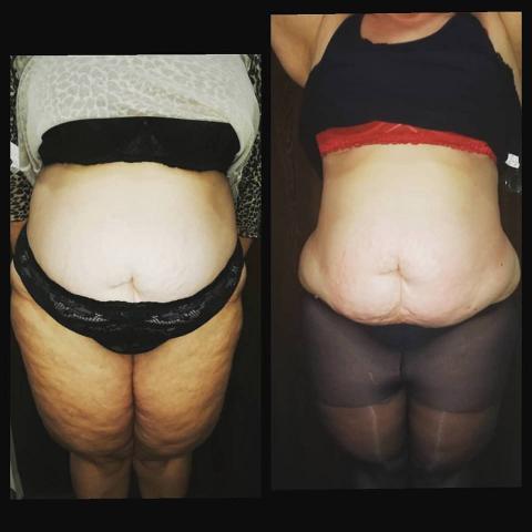 Trattamento MC1 per eliminare cellulite e grasso - LA VERA ALTERNATIVA ALLA LIPOSUZIONE