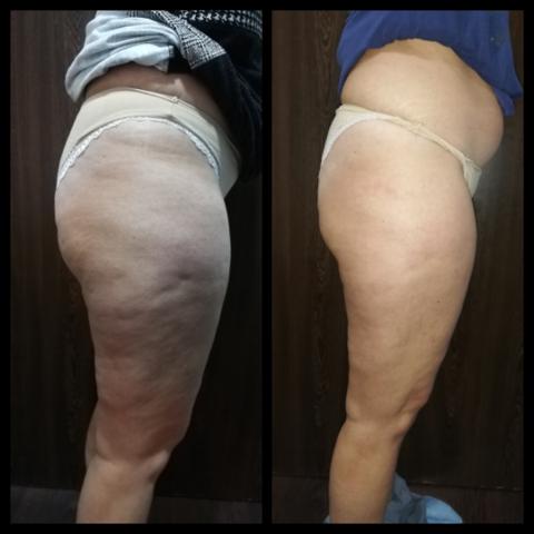 Trattamento MC1 per eliminare cellulite e grasso - LA VERA ALTERNATIVA ALLA LIPOSUZIONE