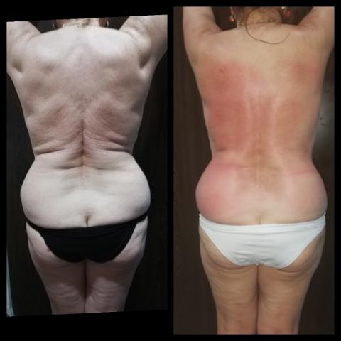 Trattamento MC1 per eliminare cellulite e grasso - LA VERA ALTERNATIVA ALLA LIPOSUZIONE