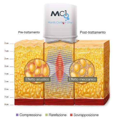 Trattamento MC1 per eliminare cellulite e grasso - LA VERA ALTERNATIVA ALLA LIPOSUZIONE