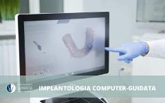 Implantologia Computer Guidata Palermo