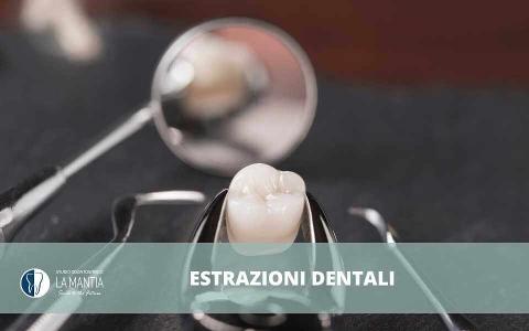Estrazioni dentali Palermo e Monreale