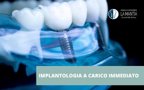 Impianti Dentali Palermo - Implantologia a carico immediato