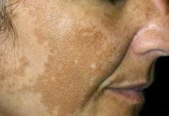 TRATTAMENTO PROFESSIONALE D'URTO COMBINATO DERMO-EPIDERMICO PER L'IPERPIGMENTAZIONE