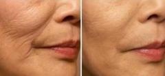 TRATTAMENTO COSMETICO RUGHE (D'URTO)