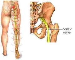 Sciatalgia - dolore sciatalgico