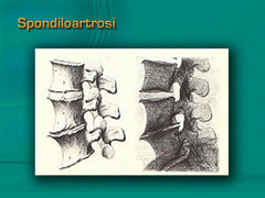 Spondiloartrosi