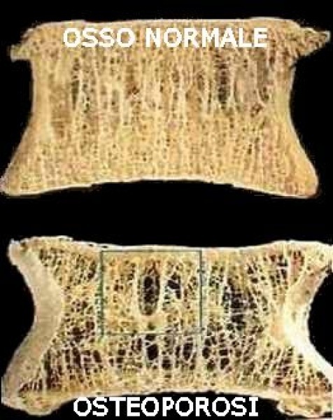 Osteoporosi - riabilitazione