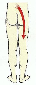 Lombosciatalgia