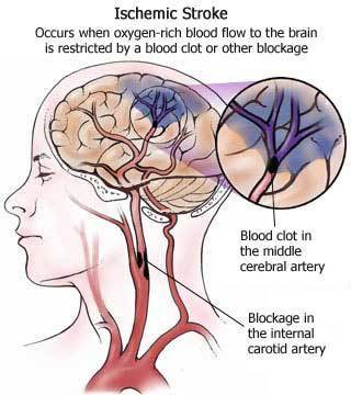 Ictus Cerebrale - riabilitazione