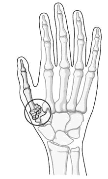 Artrosi della mano - Riabilitazione