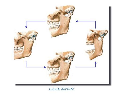 DISTURBI DELL'ARTICOLAZIONE TEMPORO-MANDIBOLARE