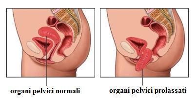 PROLASSO UTERINO - APPROCCIO RIABILITATIVO