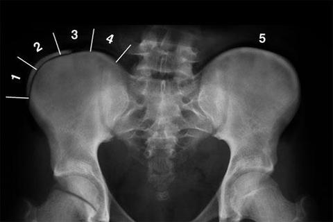 Scoliosi - cosa indica il segno di RISSER?