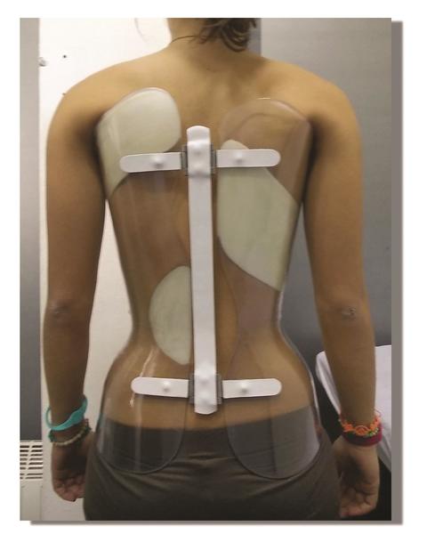 Scoliosi: Corsetto - consigli utili