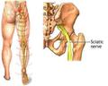Sciatalgia - dolore sciatalgico