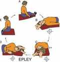 Manovra di Epley (come curare la vertigine PPB)