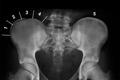 Scoliosi - cosa indica il segno di RISSER?
