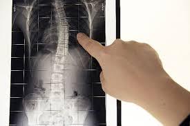 Linee Guida Nazionali per il trattamento della Scoliosi