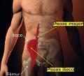 SINDROME DELL' ILEOPSOAS