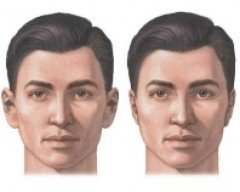 Otoplastica