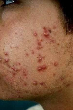 TRATTAMENT0 CICATRICI DA ACNE