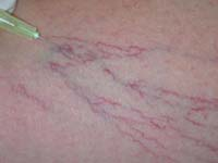 TERAPIA SCLEROSANTE