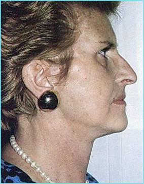 Lifting Cervico-facciale