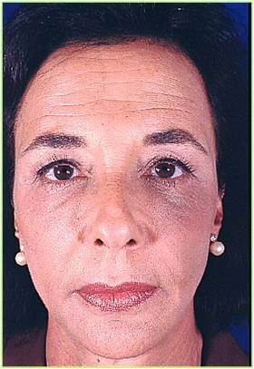 Lipofilling