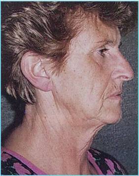 Lifting Cervico-facciale